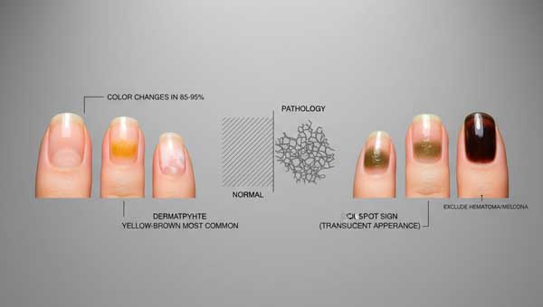 Изменение цвета и прозрачности ногтевой пластины