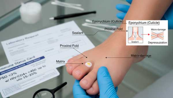 Проксимальный субунгвальный онихомикоз