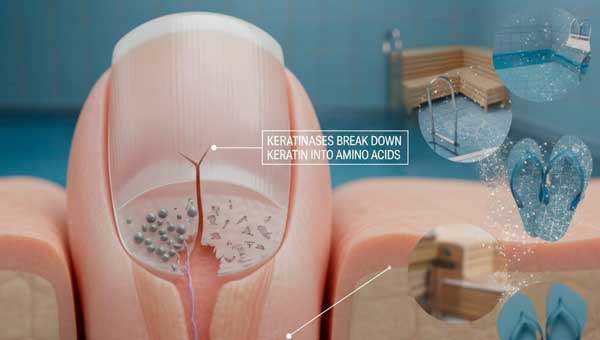 Онихомикоз: симптомы и стадии заболевания